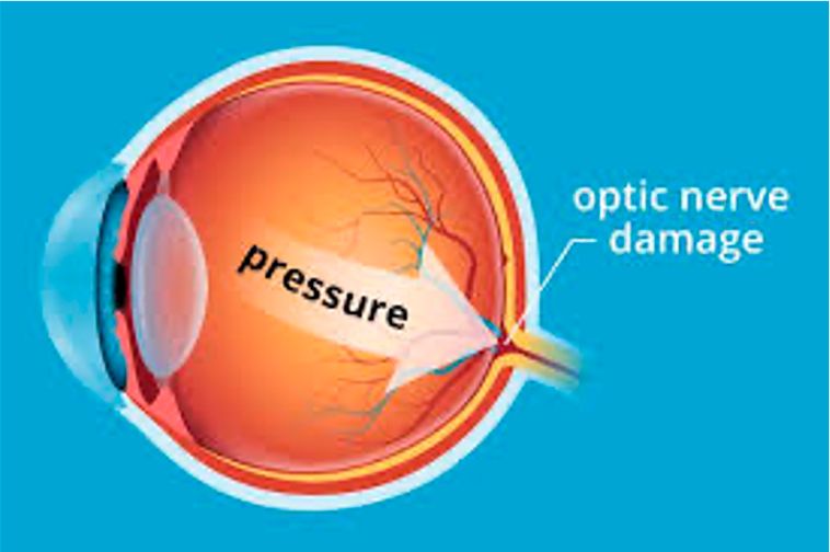 Glaucoma Roswell Eye Clinic